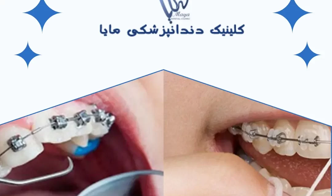 ارتودنسی سبب پوسیدگی دندان می‌شود؟