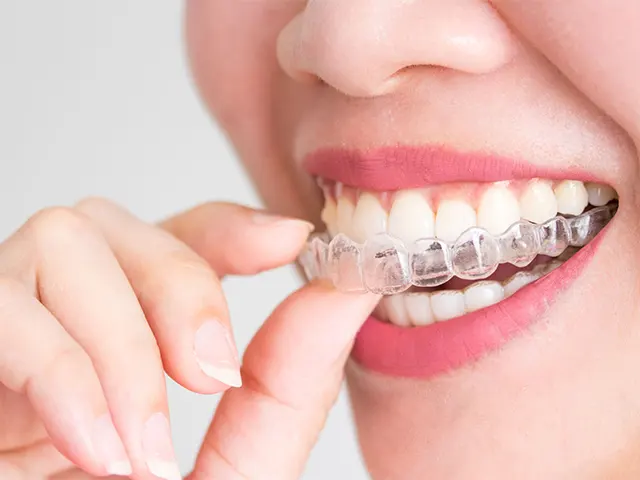 بهترین نوع ارتودنسی دندان