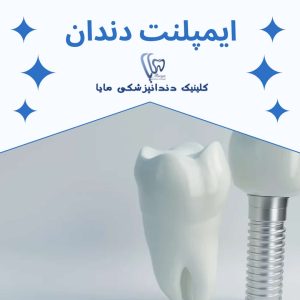 0 تا 100 ایمپلنت دندان