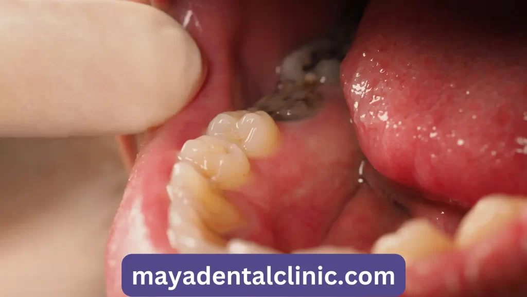 Decayed Tooth Root Canal Treatment Tooth or Teeth Decay of Lowe