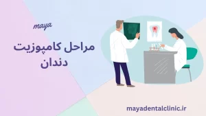 مراحل کامپوزیت دندان