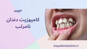 کامپوزیت دندان نامرتب و کج